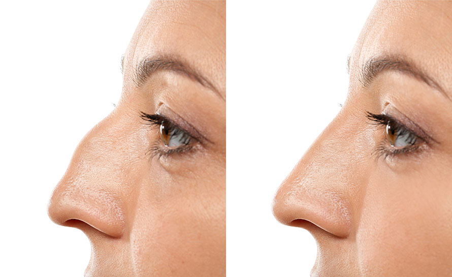 Nasal tip rotation