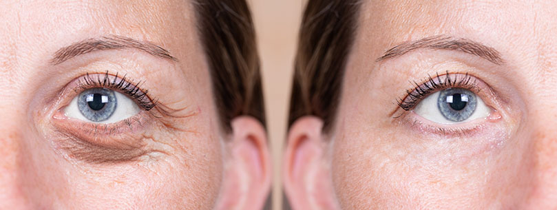 browlift or blepharoplasty