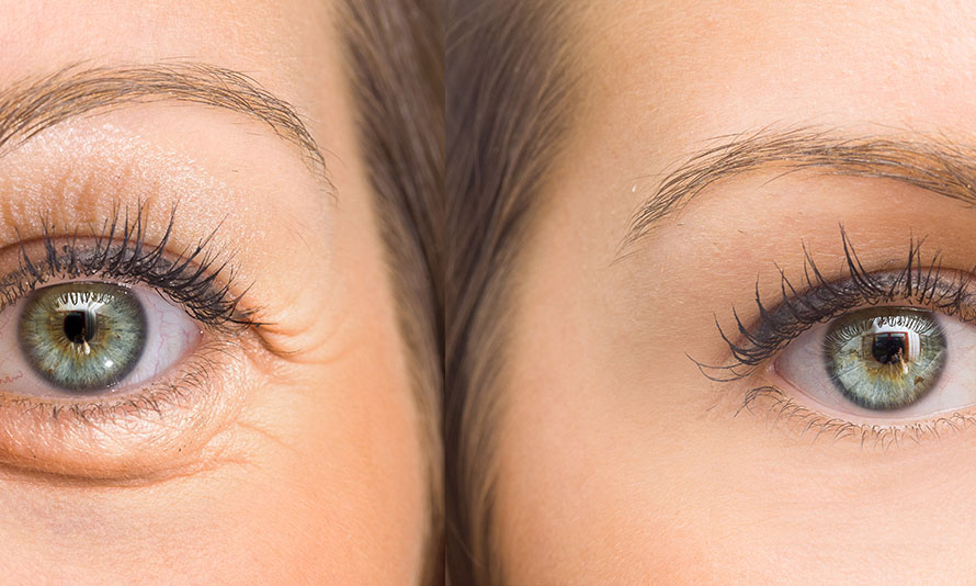 can botched blepharoplasty fixed