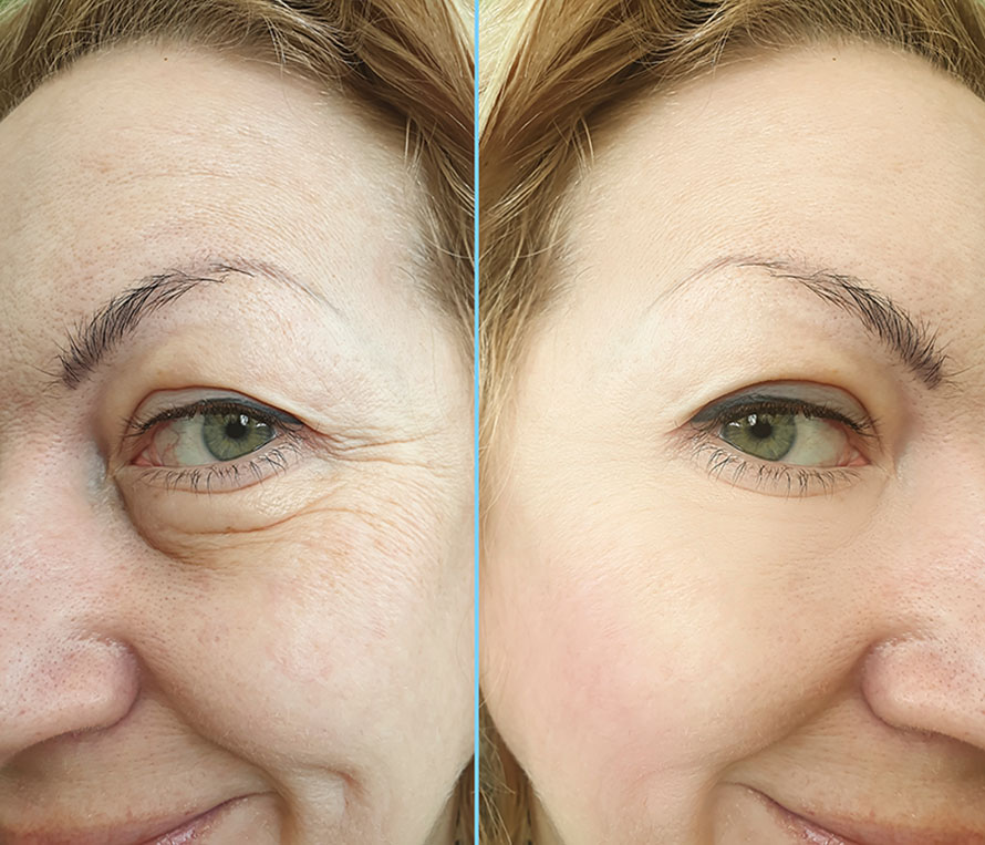 deep plane facelift