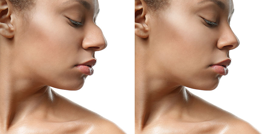 ethnic rhinoplasty