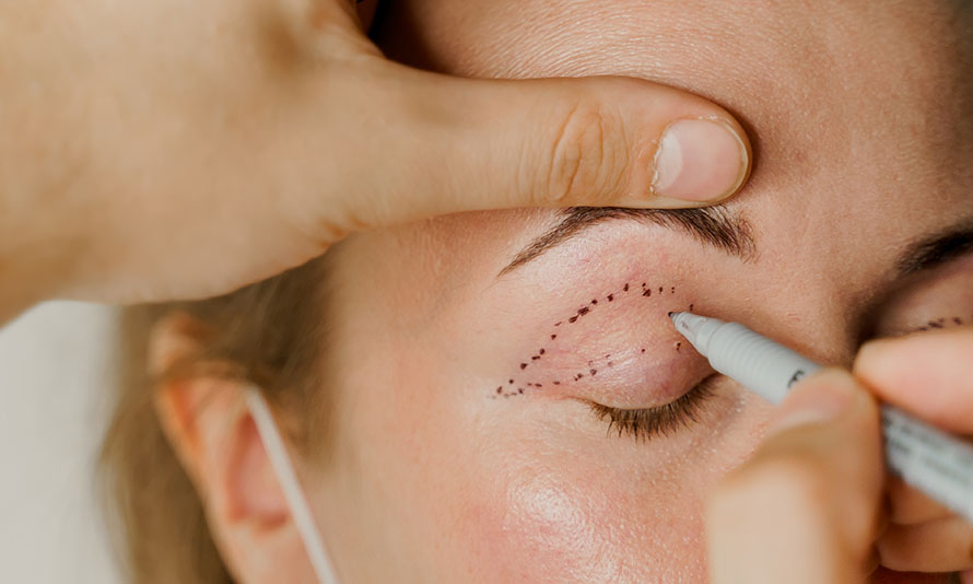 eyelid lift or ptosis