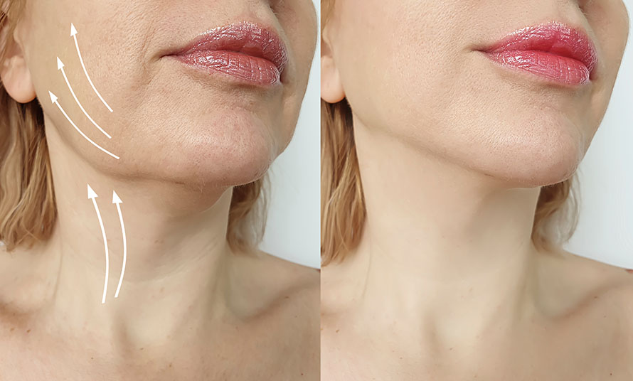 necklift