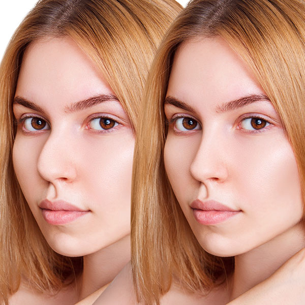 supratip rhinoplasty